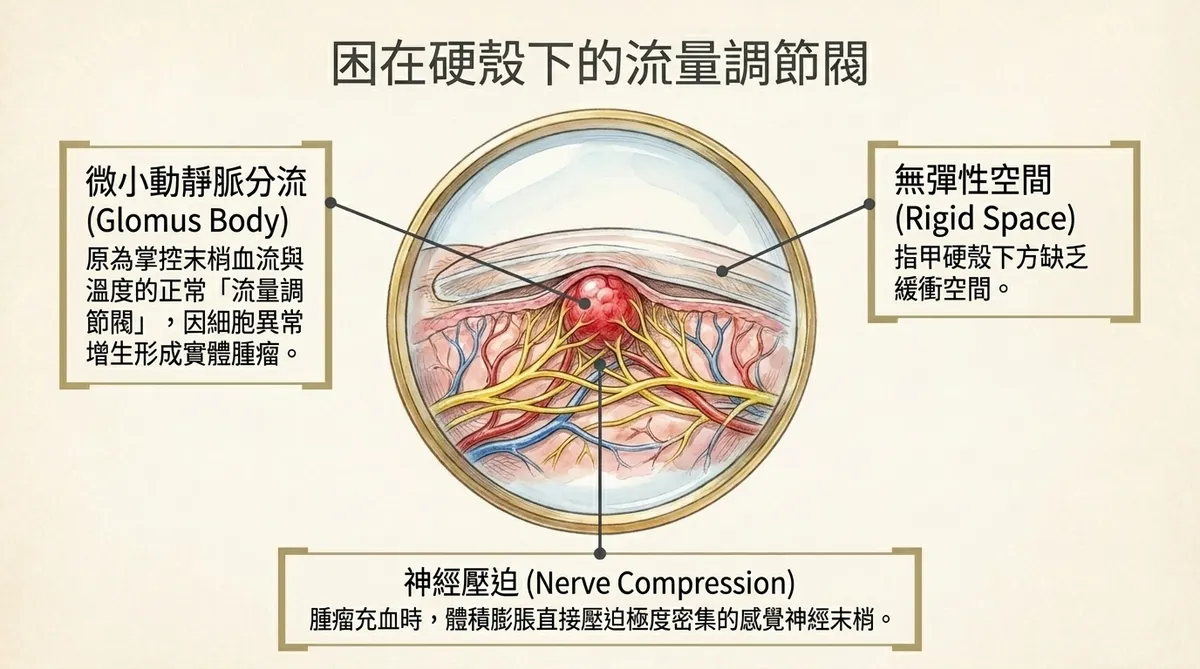 觸電般的冷水恐懼:血管球的異常痙攣。示意手指浸入冰水中,右上標示冷敏感特性:溫度驟降引發平滑肌急劇痙攣收縮;中間標示極端張力:在密閉的甲床下壓力飆升,死死掐住神經;下方標示觸覺異常:日常輕微碰撞、甚至無意間的微小震動,都會傳導為尖銳刺痛。