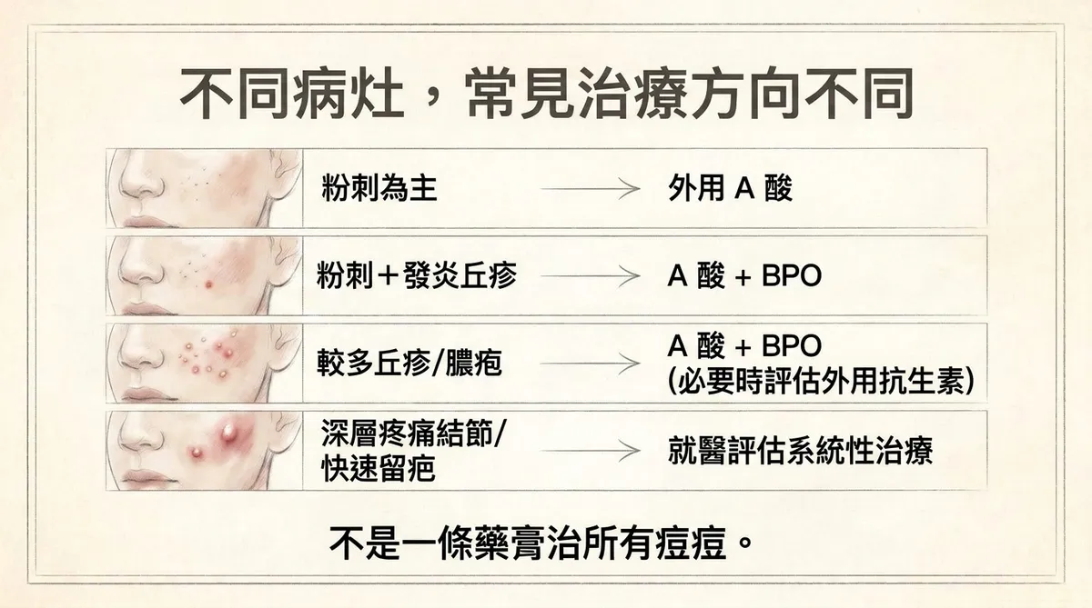 青春痘病灶與治療方向:粉刺、發炎丘疹、膿疱及深層疼痛結節需依病灶選擇不同治療策略