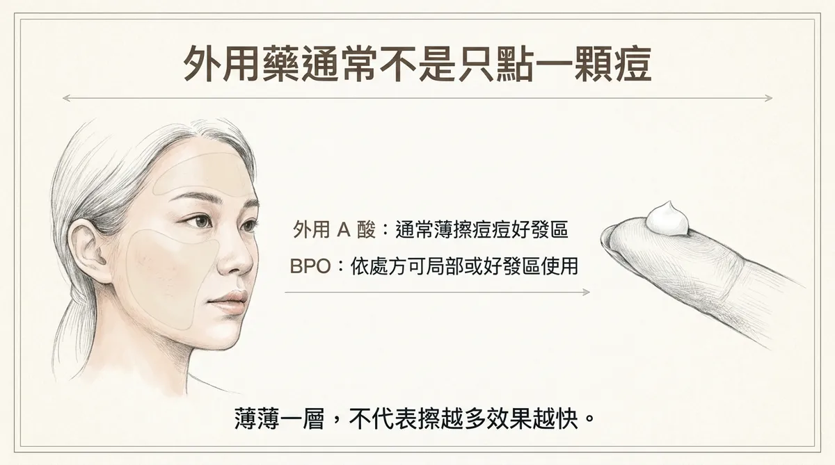青春痘外用藥塗抹範圍:外用A酸通常薄擦痘痘好發區,BPO依處方可局部或好發區使用