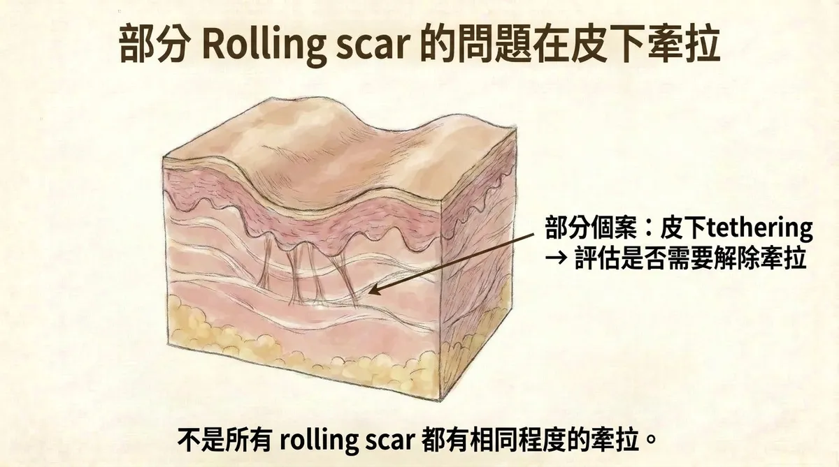 滾動型凹痘疤臨床特徵與病理機制:表面呈寬斜波浪狀起伏與皮下纖維牽拉示意圖