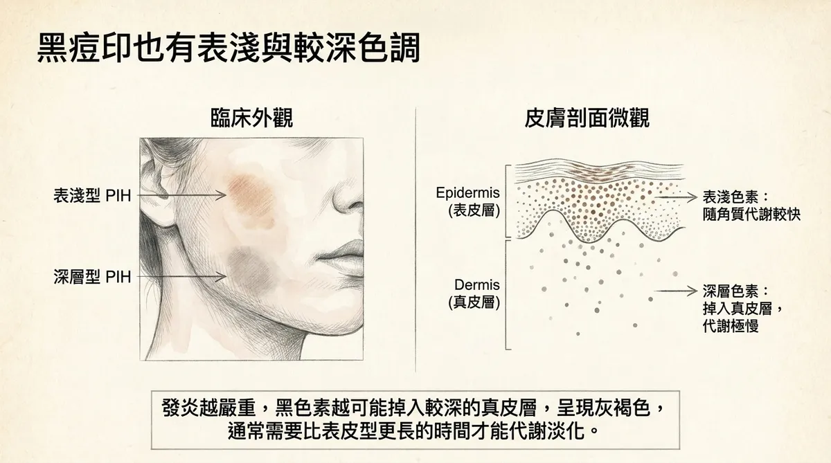 青春痘紅黑痘印自然淡化時間示意:多數印記以數月為單位逐漸變淡,但實際速度受膚色、發炎程度與日曬等因素影響