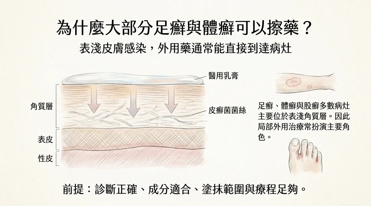 為什麼大部分足癬與體癬可以擦藥?表淺皮膚感染外用藥能直接到達病灶角質層圖解