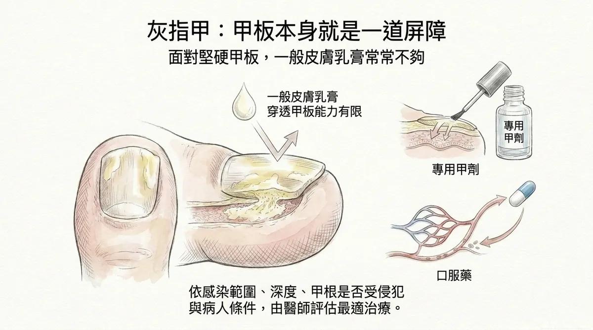 灰指甲甲板本身就是一道屏障:一般皮膚乳膏穿透有限,需依侵犯程度選擇專用甲劑或口服藥圖解