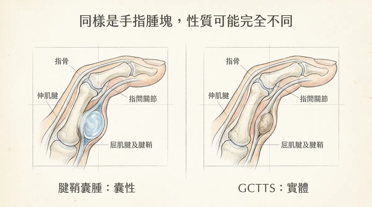 同樣是手指腫塊性質可能完全不同:腱鞘囊腫囊性與腱鞘巨細胞瘤實體對照解剖圖