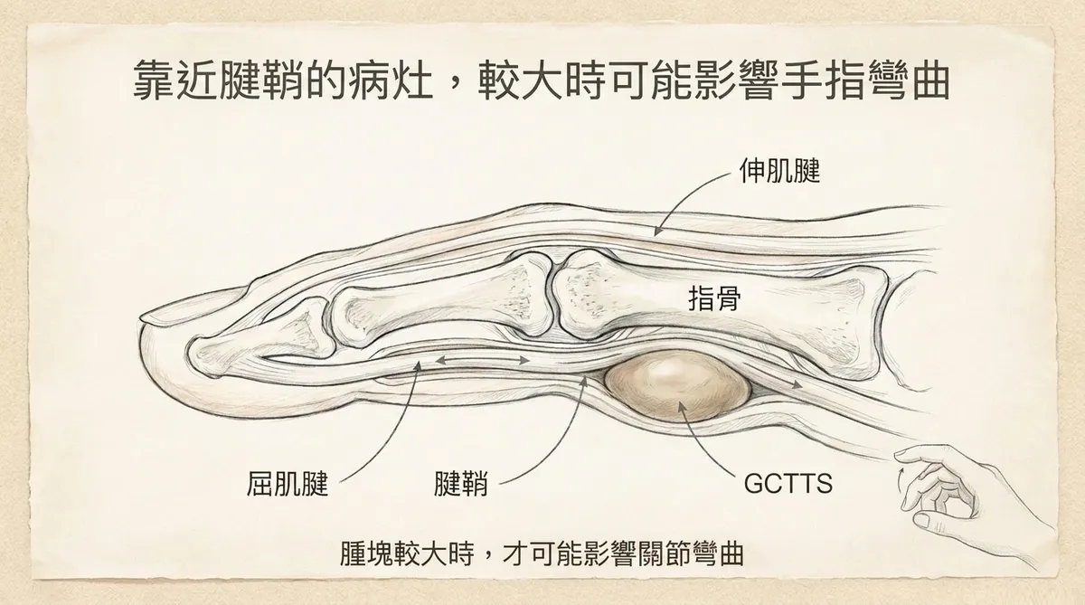 靠近腱鞘的病灶較大時可能影響手指彎曲:限制肌腱滑動影響關節活動圖解