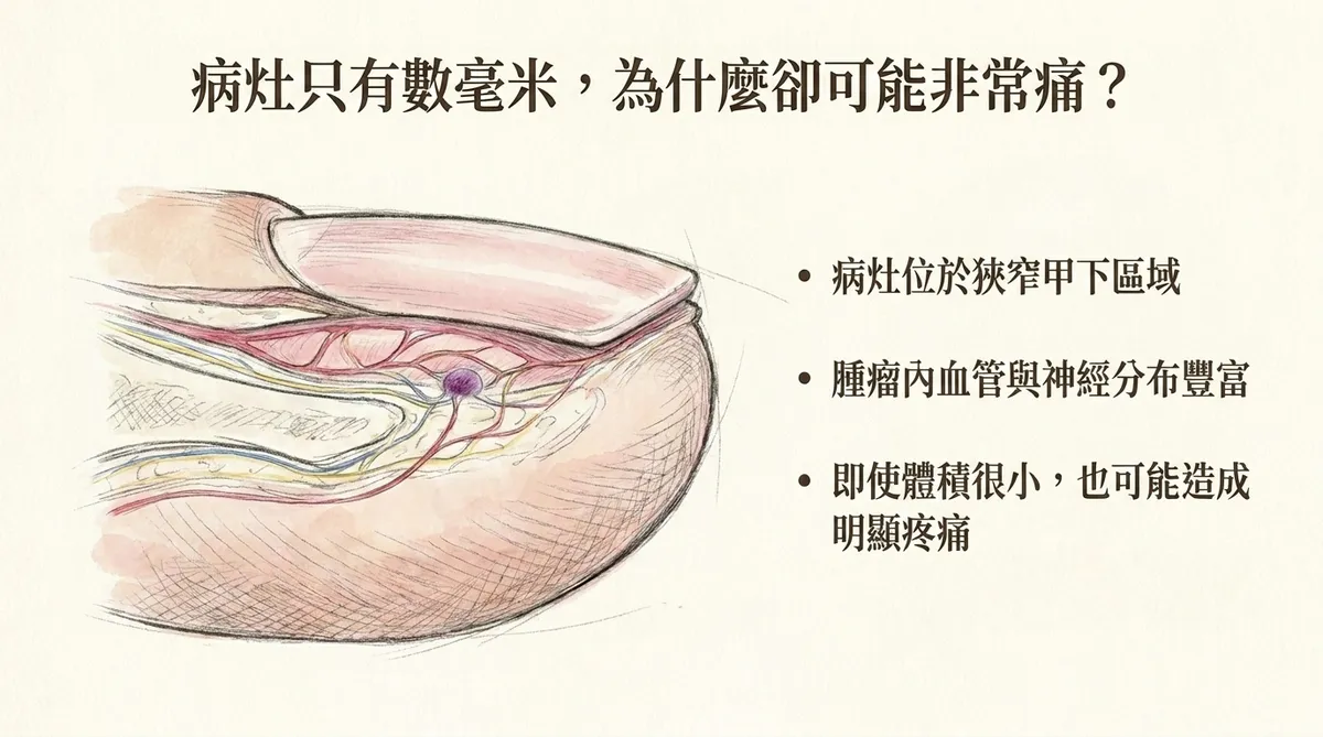 病灶只有數毫米為什麼卻可能非常痛:狹窄甲下區域、血管與神經分布豐富之病理剖面圖
