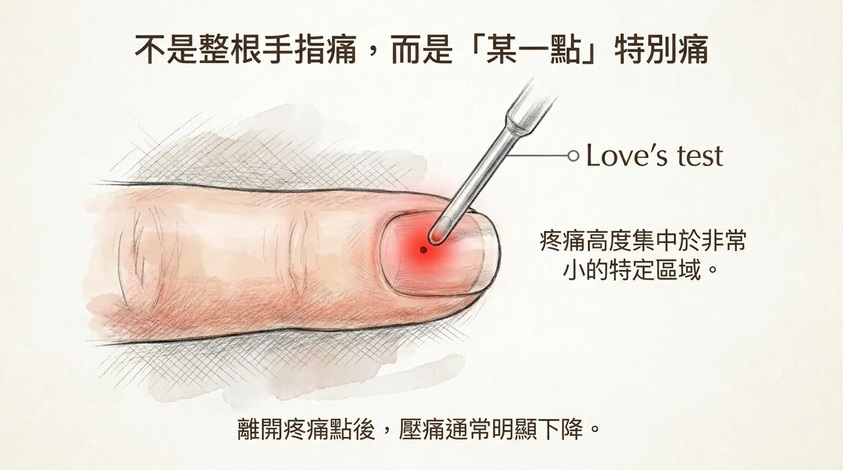 不是整根手指痛而是某一點特別痛:Love's test 定點壓痛測試臨床評估圖解