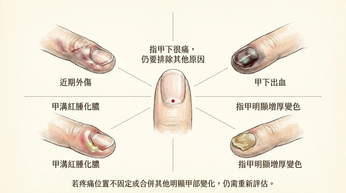 指甲下很痛仍要排除其他原因:近期外傷、甲下出血、甲溝紅腫化膿與指甲增厚變色鑑別圖