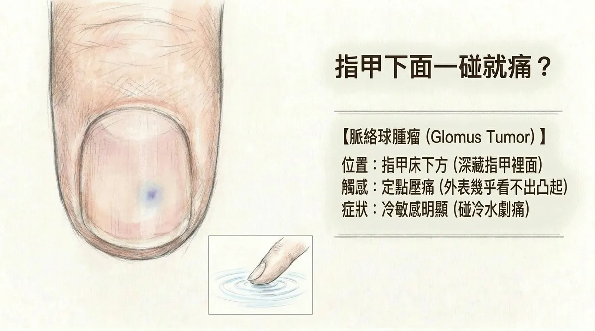 指甲下面一碰就痛脈絡球腫瘤:指甲床下方定點壓痛與碰冷水劇痛冷敏感特徵圖