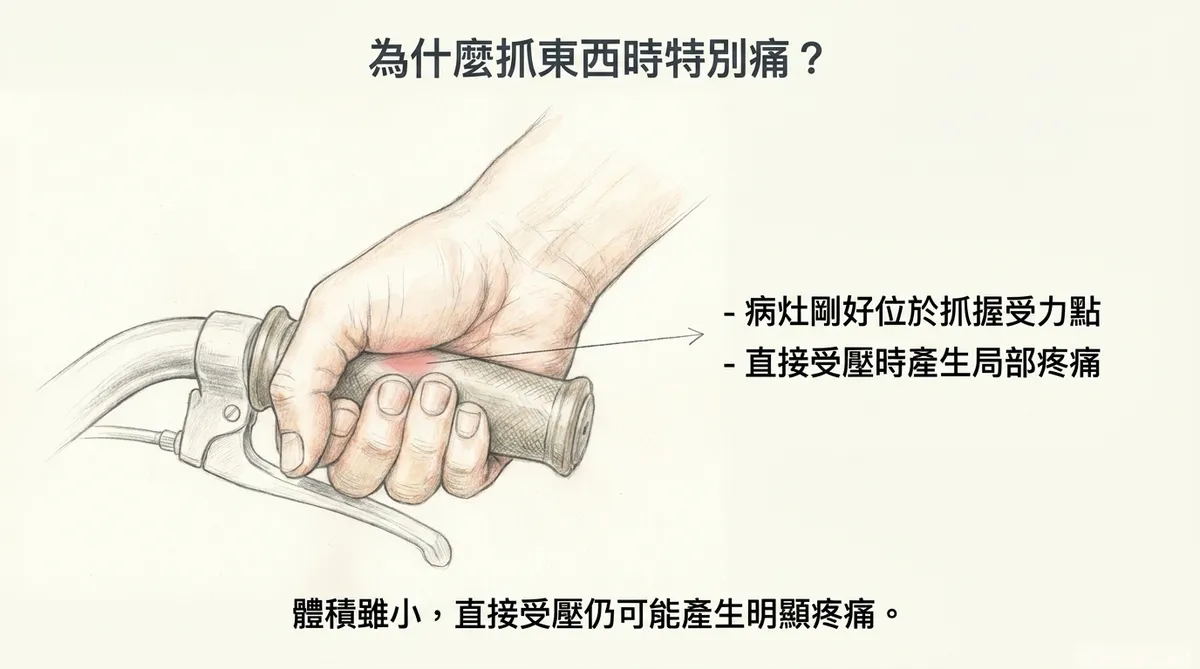 為什麼抓東西時特別痛:病灶剛好位於抓握受力點直接受壓產生局部疼痛圖解