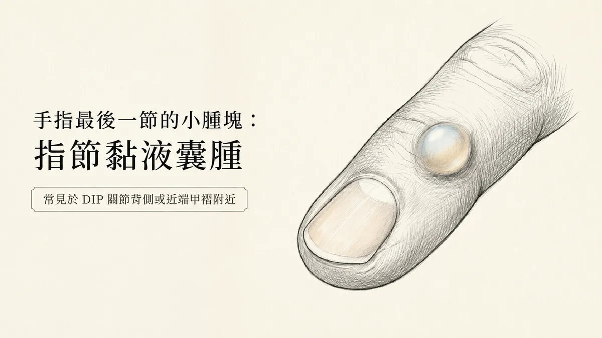 手指最後一節的小腫塊指節黏液囊腫：常見於DIP關節背側或近端甲褶附近圖解