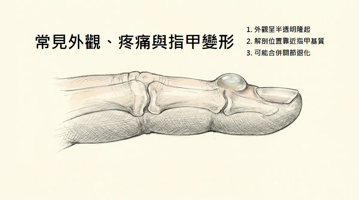 常見外觀疼痛與指甲變形：外觀呈半透明隆起、靠近指甲基質與合併關節退化側視解剖圖