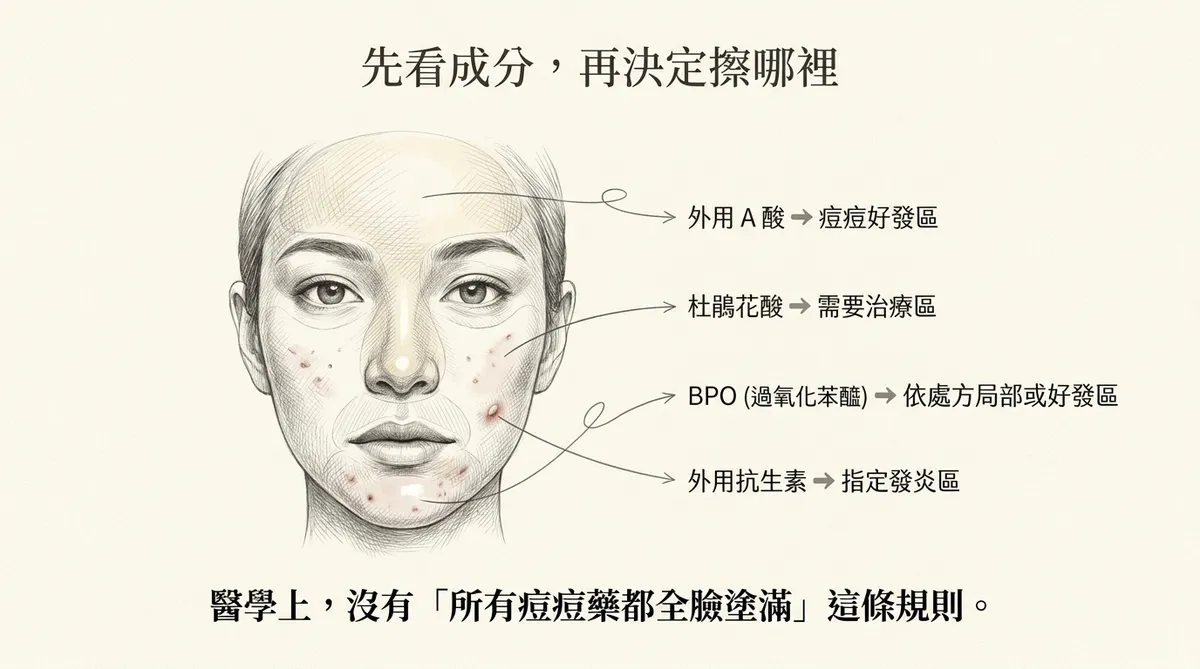外用A酸區域治療示意:痤瘡局部好發或廣泛好發時,塗抹範圍應依病灶分布與醫囑調整