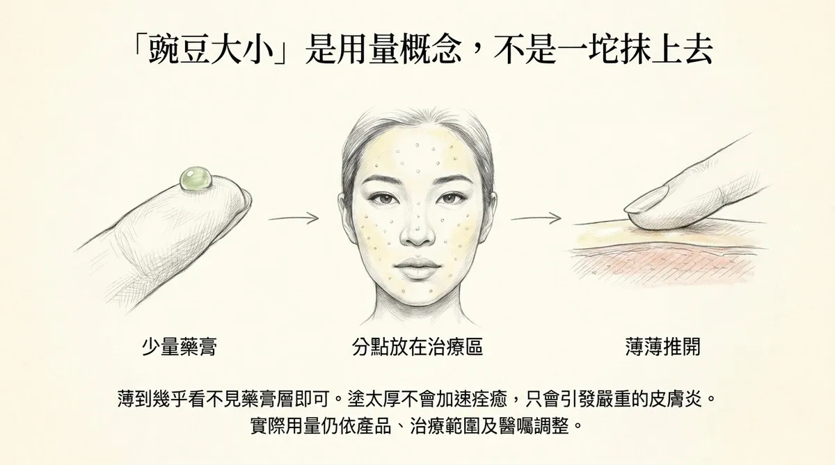 BPO塗抹範圍示意:依醫囑可局部使用於發炎痘痘,也可薄擦於發炎性痤瘡好發區