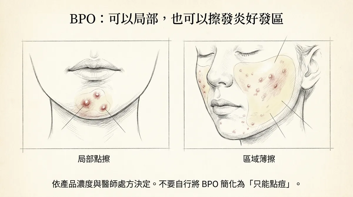青春痘外用藥早晚架構示意:早晚依醫師實際處方安排清潔、藥物、保濕與防曬