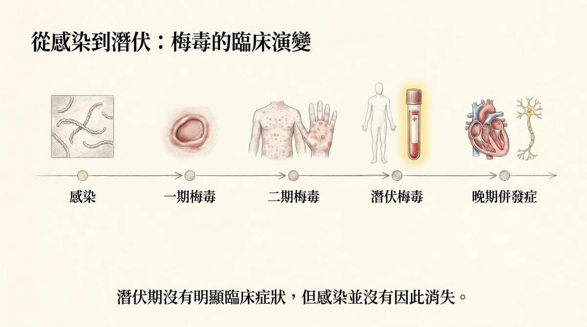 梅毒自然病程示意:從感染、一期梅毒、二期梅毒、潛伏期至晚期併發症