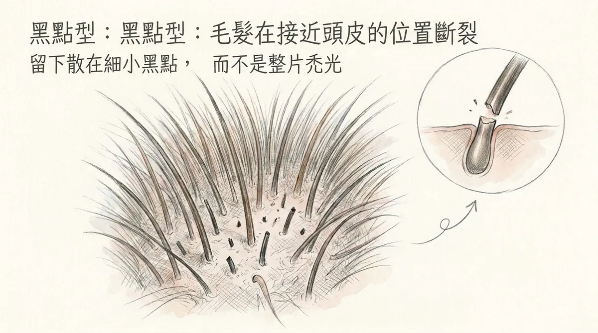 黑點型頭癬：毛髮在接近頭皮位置斷裂留下散在細小黑點，而不是整片禿光剖面圖