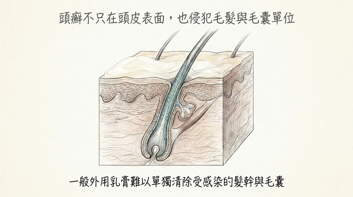 頭癬不只在頭皮表面，也侵犯毛髮與毛囊單位：一般外用乳膏難以單獨清除受感染髮幹與毛囊剖面圖