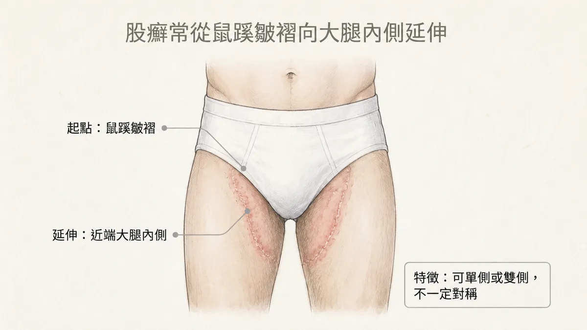 股癬常從鼠蹊皺褶向大腿內側延伸:可單側或雙側且不一定對稱分佈圖解