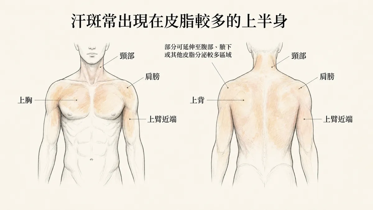 汗斑常出現在皮脂較多的上半身:上胸、上背、肩膀、頸部與上臂近端分佈示意圖