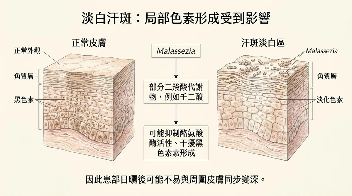 淡白汗斑局部色素形成受到影響:馬拉色菌二羧酸代謝物抑制酪氨酸酶活性干擾黑色素形成機制剖面圖