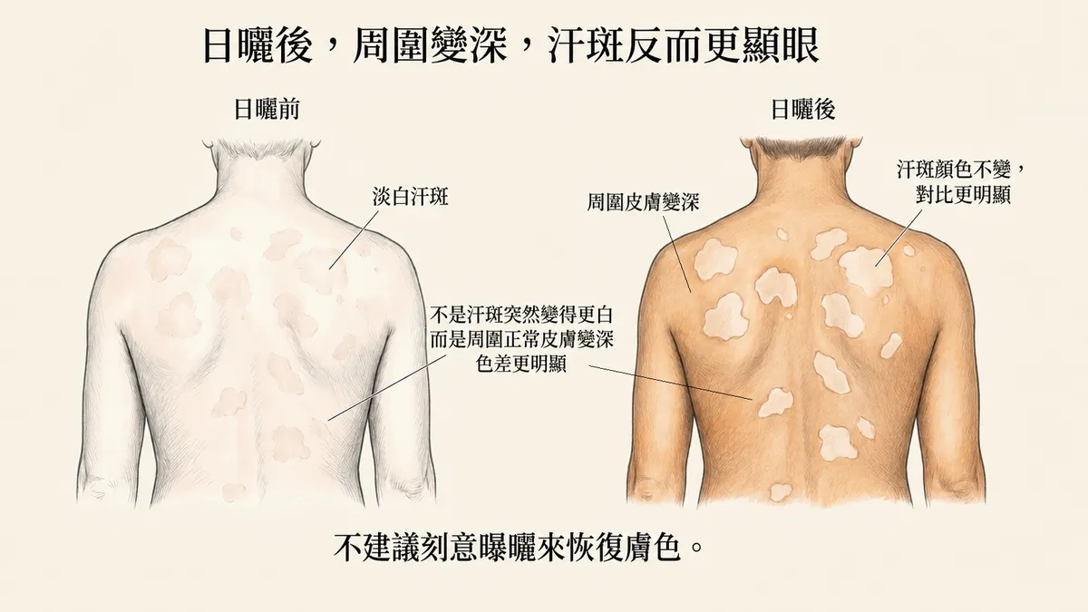 日曬後周圍變深汗斑反而更顯眼:周圍正常皮膚變深色差更明顯,不建議刻意曝曬恢復膚色說明圖
